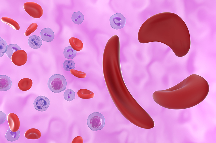 Sickle cell anaemia, illustration Illustration of red blood cells affected by sickle cell anaemia. Sickle cell anaemia is an inherited blood disease in which the red blood cells contain an abnormal form of haemoglobin  blood s oxygen carrying pigment  that causes the blood cells to become sickle shaped  right , rather than round  left . Sickle cells cannot move through small blood vessels as easily as normal cells and so can cause blockages. This prevents oxygen from reaching the tissues, causing severe pain and organ damage., by NEMES LASZLO SCIENCE PHOTO LIBRARY