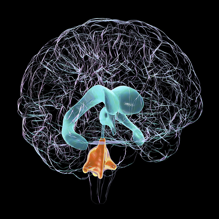 Enlarged fourth ventricle of the brain, illustration Computer illustration depicting isolated enlargement of the fourth brain ventricle., by KATERYNA KON SCIENCE PHOTO LIBRARY