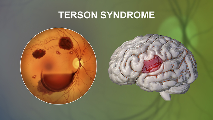 Terson syndrome, illustration Computer illustration depicting Terson syndrome, revealing intraocular haemorrhage observed during ophthalmoscopy. Terson syndrome is linked to intracranial haemorrhage or traumatic brain injury., by KATERYNA KON SCIENCE PHOTO LIBRARY