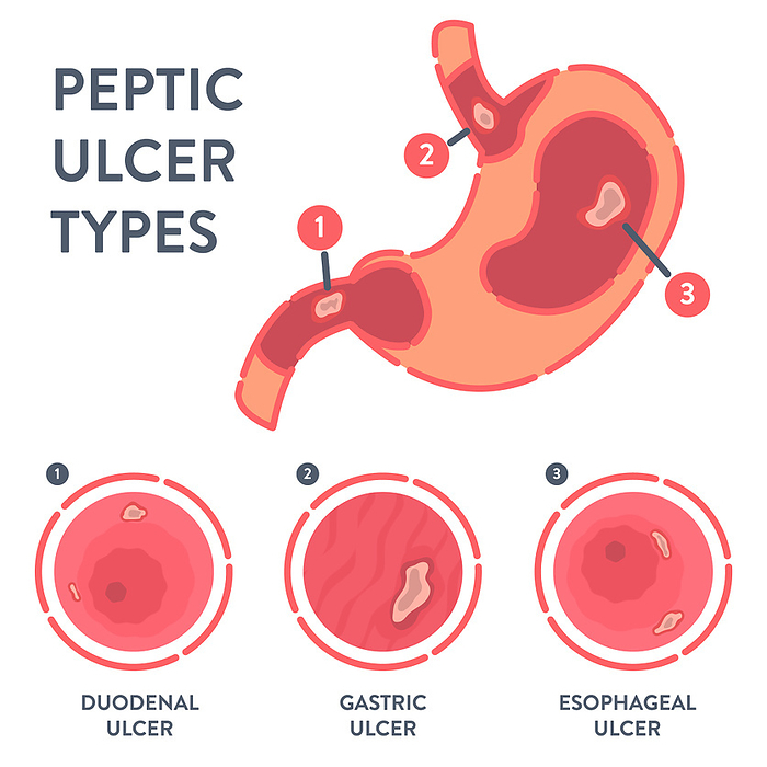 Peptic ulcer, conceptual illustration Peptic ulcer, conceptual illustration., by ART4STOCK SCIENCE PHOTO LIBRARY