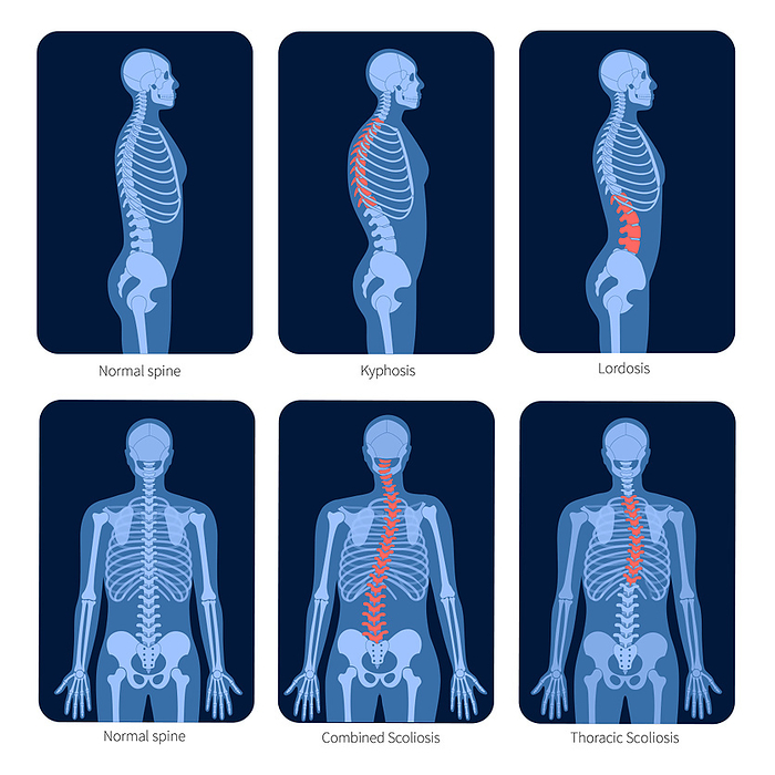 Healthy spine and scoliosis, illustration Healthy spine and scoliosis, illustration., by PIKOVIT   SCIENCE PHOTO LIBRARY