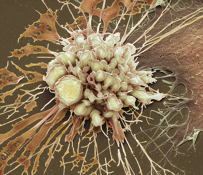 Chemotherapy induced cell death, SEM Chemotherapy induced cell death. Coloured scanning electron micrograph  SEM  of a cultured cancer cell that has become apoptotic after treatment with doxorubicin. Doxorubicin is a type of chemotherapy drug called an anthracycline. It slows or stops the growth of cancer cells in part by blocking an enzyme called topoisomerase 2. All cells need this enzyme to divide and renew. Apoptosis  also known as programmed cell death I  is one of the main ways cancer cell death is induced by chemotherapeutic drugs and is shown here with cervical cancer cells  Hela . Characteristics of apoptosis at SEM level are membrane blebs  rounded protrusions  called apoptotic bodies. In culture, apoptotic cells typically undergo further degradation in a process called secondary necrosis. Magnification: x8000 when printed at 10 centimetres wide. Specimen courtesy of Greg Towers, UCL. For a set of images showing the treated cells see C058 5931 to C058 5967., by STEVE GSCHMEISSNER SCIENCE PHOTO LIBRARY