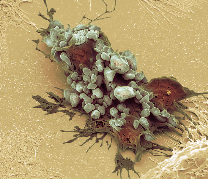 Chemotherapy induced cell death, SEM Chemotherapy induced cell death. Coloured scanning electron micrograph  SEM  of a cultured cancer cell that has become apoptotic after treatment with doxorubicin. Doxorubicin is a type of chemotherapy drug called an anthracycline. It slows or stops the growth of cancer cells in part by blocking an enzyme called topoisomerase 2. All cells need this enzyme to divide and renew. Apoptosis  also known as programmed cell death I  is one of the main ways cancer cell death is induced by chemotherapeutic drugs and is shown here with cervical cancer cells  Hela . Characteristics of apoptosis at SEM level are membrane blebs  rounded protrusions  called apoptotic bodies. In culture, apoptotic cells typically undergo further degradation in a process called secondary necrosis. Magnification: x8000 when printed at 10 centimetres wide. Specimen courtesy of Greg Towers, UCL. For a set of images showing the treated cells see C058 5931 to C058 5967., by STEVE GSCHMEISSNER SCIENCE PHOTO LIBRARY