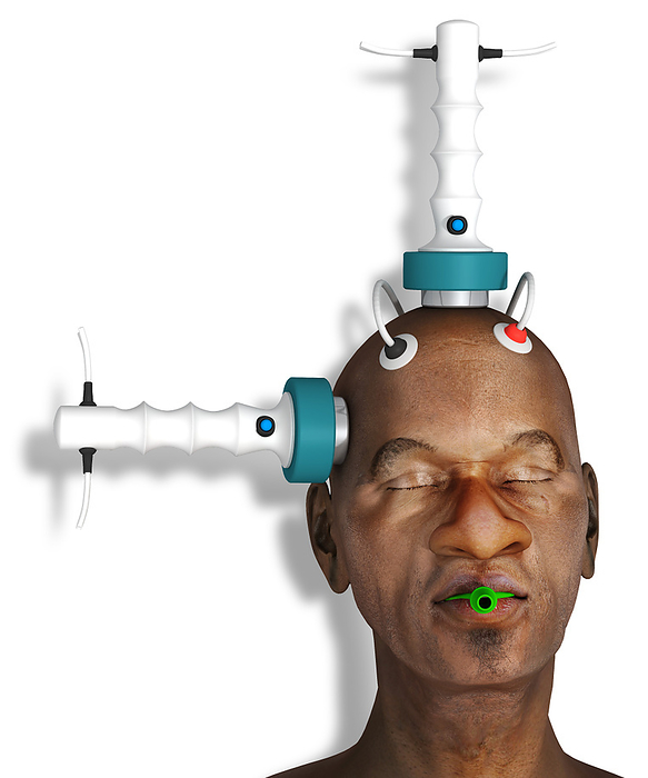 Electroconvulsive therapy, illustration Illustration of a patient undergoing electroconvulsive therapy  ECT . The electrodes placed at the right temple and near the top of the head will deliver an electrical current that will induce a seizure in the patient s brain. This right unilateral placement of the electrodes may lessen memory loss compared to bilateral  at both temples  electrode placement. Brain activity is monitored by the electrodes placed above the forehead. ECT is given under a general anaesthetic and the mouth guard prevents the patient from biting their tongue. ECT is used to treat some severe mental illnesses when other treatments haven t helped. It is effective in some cases, although why it works is not fully understood. Use of the treatment can be controversial, especially as in the past it was used while patients were still conscious and often without their consent., by JOSE ANTONIO PE AS SCIENCE PHOTO LIBRARY