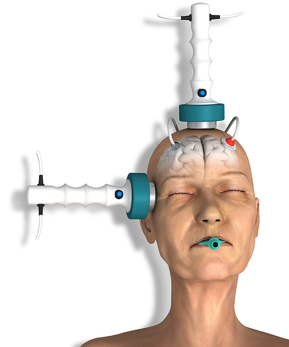 Electroconvulsive therapy, illustration Illustration of a patient undergoing electroconvulsive therapy  ECT . The electrodes placed at the right temple and near the top of the head will deliver an electrical current that will induce a seizure in the patient s brain. This right unilateral placement of the electrodes may lessen memory loss compared to bilateral  at both temples  electrode placement. Brain activity is monitored by the electrodes placed above the forehead. ECT is given under a general anaesthetic and the mouth guard prevents the patient from biting their tongue. ECT is used to treat some severe mental illnesses when other treatments haven t helped. It is effective in some cases, although why it works is not fully understood. Use of the treatment can be controversial, especially as in the past it was used while patients were still conscious and often without their consent., by JOSE ANTONIO PE AS SCIENCE PHOTO LIBRARY