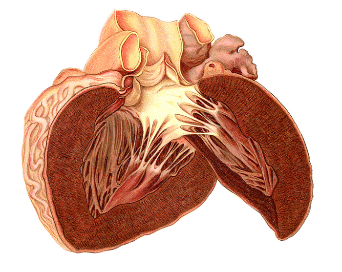 Heart atrophy, illustration Heart atrophy. Illustration of a condition called brown atrophy of the heart where the organ is reduced in size, the chambers of the ventricles are narrowed and the cardiac muscle is discoloured brown and of firm consistency. The heart walls appear thickened due mostly to the diminished cavities. The brown colour of the heart is due to excessive deposits of lipofuscin pigments within the cardiac muscle cells. Atrophy of the heart is a common feature of ageing. From Bollinger, O. 1901 Atlas und Gundriss der Pathologischen Anatomie, vol 1. Lehmann, Munich., by MICROSCAPE SCIENCE PHOTO LIBRARY