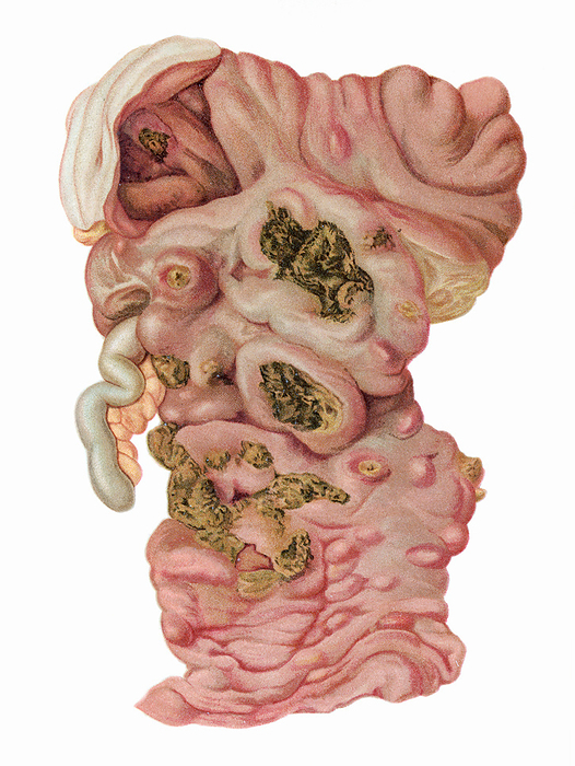 Typhoid fever, illustration Typhoid fever, illustration. Infection with Salmonella typhi showing swollen mucosa of the ileum with numerous ulcers containing greenish coloured necrotic tissue. The larger ulcers correspond to infected Peyer s patches, the smaller ones from solitary lymphoid follicles. Above, the caecum also displays ulceration. S. typhi is acquired from infected water and food. It invades the gut mucosa and lymphoid tissue, causing ulceration, necrosis and frequent bleeding with possible perforation producing infective peritonitis. If untreated, death is not uncommon. Early antibiotic treatment is effective as a cure. From Bollinger, O. 1901 Atlas und Gundriss der Pathologischen Anatomie, vol 1. Lehmann, Munich., by MICROSCAPE SCIENCE PHOTO LIBRARY