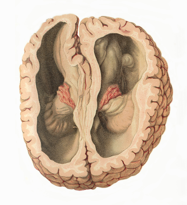 Hydrocephalus, illustration Hydrocephalus, illustration. Example of congenital hydrocephalus in which there is an excessive amount of intracranial cerebrospinal fluid  CSF . This results in dilated lateral ventricles filled with CSF and in comparison to the gray matter of the cerebral cortex, the white matter is markedly diminished. A common cause is atresia  abnormal development obstruction  of the aqueduct of Sylvius resulting in obstructed flow of CSF and ventricular dilation. In utero the head may attain a huge size. Convulsions, blindness, motor impairment are common as is death. From Bollinger, O. 1901 Atlas und Gundriss der Pathologischen Anatomie, vol 2. Lehmann, Munich., by MICROSCAPE SCIENCE PHOTO LIBRARY