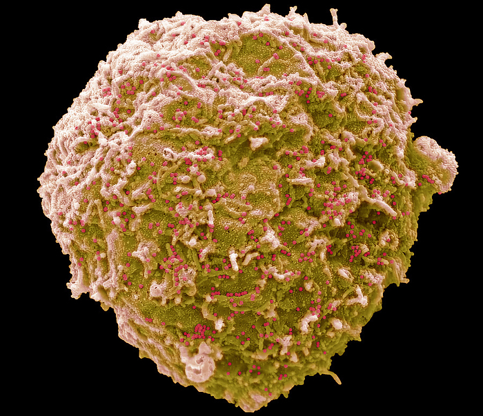 Adenovirus, SEM Human adenovirus strain J.J. subtype D 10  HAdV 10 . Scanning electron micrograph  SEM  of a human alveolar basal epithelial cell  A549 cell line  infected with HAdV 10. The image shows an infected cell yellow  that has not undergone lysis. The cells plasma membrane is decorated with 100nm diameter non enveloped HAdV 10 virus particles  red  released from other lysed infected cells from the culture. Adenoviruses are a group of viruses that can cause mild to severe infection throughout the body. Adenovirus infections most commonly affect the respiratory system, eyes, and the gastrointestinal tract. These infections can cause symptoms similar to the common cold and flu or pneumonia, conjunctivitis, or acute gastroenteritis. Most adenovirus infections are mild. Magnification: x 3000 when printed 10 centimetres wide. Specimen courtesy of Virology Research Services Ltd  Scott Lawrence ., by STEVE GSCHMEISSNER SCIENCE PHOTO LIBRARY