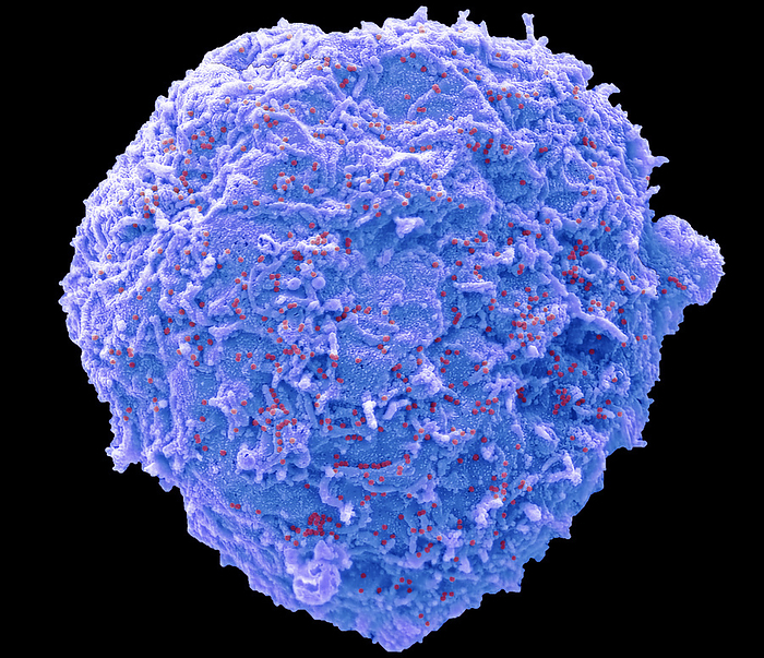 Adenovirus, SEM Human adenovirus strain J.J. subtype D 10  HAdV 10 . Scanning electron micrograph  SEM  of a human alveolar basal epithelial cell  A549 cell line  infected with HAdV 10. The image shows an infected cell  blue  that has not undergone lysis. The cells plasma membrane is decorated with 100nm diameter non enveloped HAdV 10 virus particles  red  released from other lysed infected cells from the culture. Adenoviruses are a group of viruses that can cause mild to severe infection throughout the body. Adenovirus infections most commonly affect the respiratory system, eyes, and the gastrointestinal tract. These infections can cause symptoms similar to the common cold and flu or pneumonia, conjunctivitis, or acute gastroenteritis. Most adenovirus infections are mild. Magnification: x 3000 when printed 10 centimetres wide. Specimen courtesy of Virology Research Services Ltd  Scott Lawrence ., by STEVE GSCHMEISSNER SCIENCE PHOTO LIBRARY