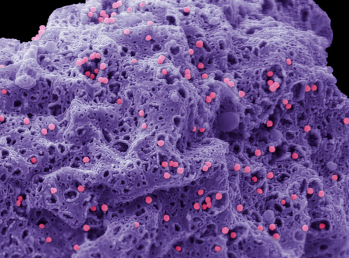 Adenovirus, SEM Human adenovirus strain J.J. subtype D 10  HAdV 10 . Scanning electron micrograph  SEM  of a human alveolar basal epithelial cell  A549 cell line  infected with HAdV 10.. The image shows a cell that has been infected with HAdV 10 for 3 days and is in the process of undergoing lysis releasing intracellular newly synthesised viral particles through pores in the plasma membrane  100nm pink particles . Adenoviruses are a group of viruses that can cause mild to severe infection throughout the body. Adenovirus infections most commonly affect the respiratory system, eyes, and the gastrointestinal tract. These infections can cause symptoms similar to the common cold and flu or pneumonia, conjunctivitis, or acute gastroenteritis. Most adenovirus infections are mild. Magnification: x 10000 when printed 10 centimetres wide. Specimen courtesy of Virology Research Services Ltd  Scott Lawrence ., by STEVE GSCHMEISSNER SCIENCE PHOTO LIBRARY
