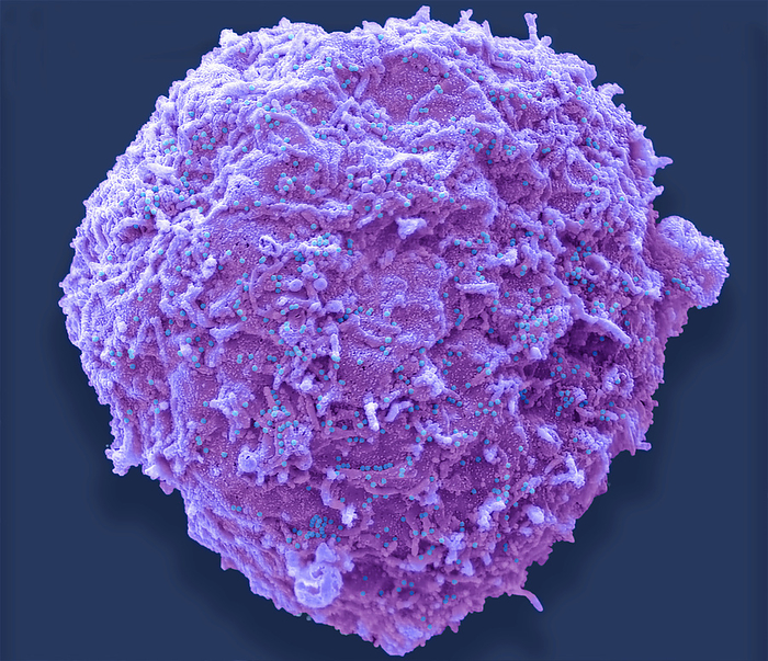 Adenovirus, SEM Human adenovirus strain J.J. subtype D 10  HAdV 10 . Scanning electron micrograph  SEM  of a human alveolar basal epithelial cell  A549 cell line  infected with HAdV 10. The image shows an infected cell purple  that has not undergone lysis. The cells plasma membrane is decorated with 100nm diameter non enveloped HAdV 10 virus particles  blue  released from other lysed infected cells from the culture. Adenoviruses are a group of viruses that can cause mild to severe infection throughout the body. Adenovirus infections most commonly affect the respiratory system, eyes, and the gastrointestinal tract. These infections can cause symptoms similar to the common cold and flu or pneumonia, conjunctivitis, or acute gastroenteritis. Most adenovirus infections are mild. Magnification: x 3000 when printed 10 centimetres wide. Specimen courtesy of Virology Research Services Ltd  Scott Lawrence ., by STEVE GSCHMEISSNER SCIENCE PHOTO LIBRARY