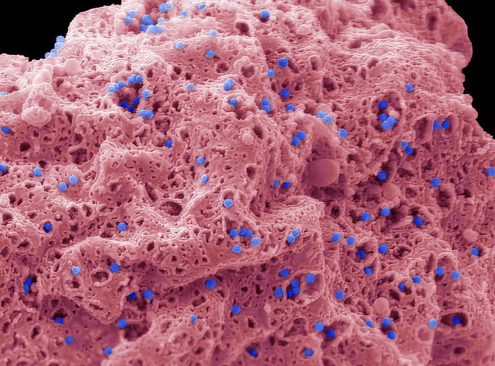 Adenovirus, SEM Human adenovirus strain J.J. subtype D 10  HAdV 10 . Scanning electron micrograph  SEM  of a human alveolar basal epithelial cell  A549 cell line  infected with HAdV 10. The image shows a cell that has been infected with HAdV 10 for 3 days and is in the process of undergoing lysis releasing intracellular newly synthesised viral particles through pores in the plasma membrane  100nm blue particles . Adenoviruses are a group of viruses that can cause mild to severe infection throughout the body. Adenovirus infections most commonly affect the respiratory system, eyes, and the gastrointestinal tract. These infections can cause symptoms similar to the common cold and flu or pneumonia, conjunctivitis, or acute gastroenteritis. Most adenovirus infections are mild. Magnification: x 10000 when printed 10 centimetres wide. Specimen courtesy of Virology Research Services Ltd  Scott Lawrence ., by STEVE GSCHMEISSNER SCIENCE PHOTO LIBRARY
