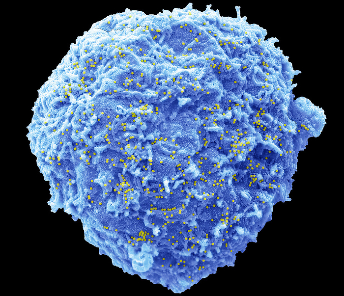 Adenovirus, SEM Human adenovirus strain J.J. subtype D 10  HAdV 10 . Scanning electron micrograph  SEM  of a human alveolar basal epithelial cell  A549 cell line  infected with HAdV 10. The image shows an infected cell  blue  that has not undergone lysis. The cells plasma membrane is decorated with 100nm diameter non enveloped HAdV 10 virus particles  yellow  released from other lysed infected cells from the culture. Adenoviruses are a group of viruses that can cause mild to severe infection throughout the body. Adenovirus infections most commonly affect the respiratory system, eyes, and the gastrointestinal tract. These infections can cause symptoms similar to the common cold and flu or pneumonia, conjunctivitis, or acute gastroenteritis. Most adenovirus infections are mild. Magnification: x 3000 when printed 10 centimetres wide. Specimen courtesy of Virology Research Services Ltd  Scott Lawrence ., by STEVE GSCHMEISSNER SCIENCE PHOTO LIBRARY