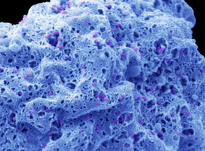 Adenovirus, SEM Human adenovirus strain J.J. subtype D 10  HAdV 10 . Scanning electron micrograph  SEM  of a human alveolar basal epithelial cell  A549 cell line  infected with HAdV 10. The image shows a cell that has been infected with HAdV 10 for 3 days and is in the process of undergoing lysis releasing intracellular newly synthesised viral particles through pores in the plasma membrane  100nm purple particles . Adenoviruses are a group of viruses that can cause mild to severe infection throughout the body. Adenovirus infections most commonly affect the respiratory system, eyes, and the gastrointestinal tract. These infections can cause symptoms similar to the common cold and flu or pneumonia, conjunctivitis, or acute gastroenteritis. Most adenovirus infections are mild. Magnification: x 10000 when printed 10 centimetres wide. Specimen courtesy of Virology Research Services Ltd  Scott Lawrence ., by STEVE GSCHMEISSNER SCIENCE PHOTO LIBRARY