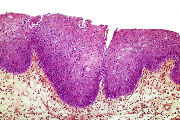 Vaginitis, LM Vaginitis. Light micrograph of a section from an affected vagina. Vaginitis is infectious or non infectious inflammation of the vaginal mucosa, sometimes with inflammation of the vulva. Symptoms include vaginal discharge, irritation, pruritus, and erythema. Diagnosis is by evaluation of vaginal secretions. Treatment is directed at the cause and at any severe symptoms. Thickening of the epithelium with a large number of polymorphonuclear leukocytes present is shown in this image. Mag: x100 when printed at 10 centimetres wide. Human tissue., by STEVE GSCHMEISSNER SCIENCE PHOTO LIBRARY
