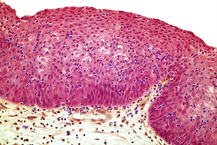 Vaginitis, LM Vaginitis. Light micrograph of a section from an affected vagina. Vaginitis is infectious or non infectious inflammation of the vaginal mucosa, sometimes with inflammation of the vulva. Symptoms include vaginal discharge, irritation, pruritus, and erythema. Diagnosis is by evaluation of vaginal secretions. Treatment is directed at the cause and at any severe symptoms. Thickening of the epithelium with a large number of polymorphonuclear leukocytes present is shown in this image. Mag: x160 when printed at 10 centimetres wide. Human tissue., by STEVE GSCHMEISSNER SCIENCE PHOTO LIBRARY