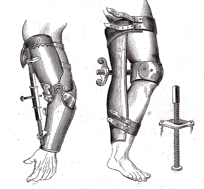 Devices for treating ankylosis, 19th century illustration Illustration of devices for treating ankylosis. Ankylosis is the fusion of bones, leading to stiff or immobile joints. From  Dictionary of Medicine, Vol 2  by Dr Jaccoud, Paris, 1865., by COLLECTION ABECASIS SCIENCE PHOTO LIBRARY