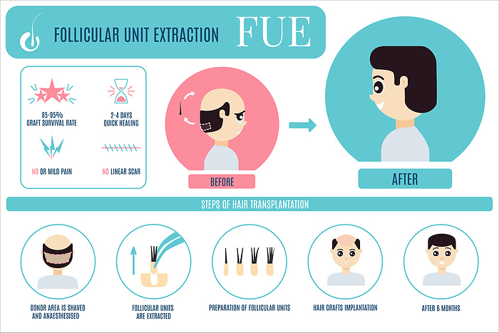 FUE hair transplantation, conceptual illustration FUE  follicular unit extraction  hair transplantation in men, illustration., by ART4STOCK SCIENCE PHOTO LIBRARY