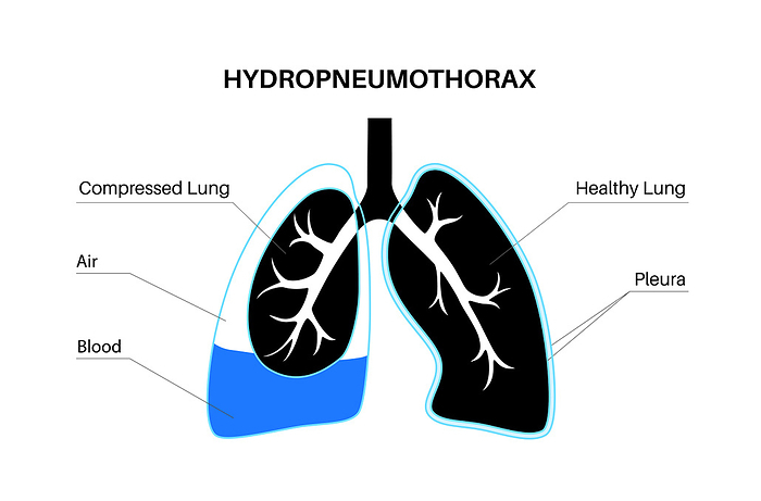 Hydropneumothorax, illustration Hydropneumothorax, illustration., by PIKOVIT   SCIENCE PHOTO LIBRARY