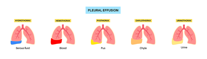 Pleural effusion, illustration Pleural effusion, illustration., by PIKOVIT   SCIENCE PHOTO LIBRARY
