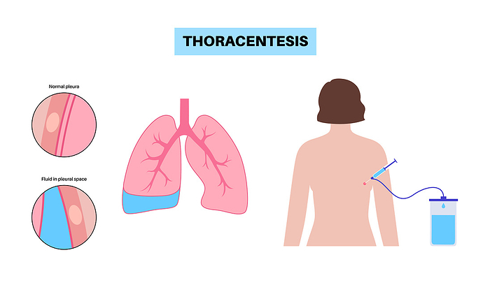 Thoracentesis medical procedure, illustration Thoracentesis medical procedure, illustration., by PIKOVIT   SCIENCE PHOTO LIBRARY