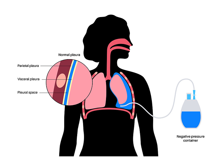 Tunnelled pleural catheter, illustration Tunnelled pleural catheter, illustration., by PIKOVIT   SCIENCE PHOTO LIBRARY