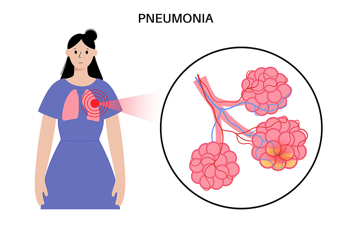 Pneumonia infection, conceptual illustration Pneumonia infection, conceptual illustration., by PIKOVIT   SCIENCE PHOTO LIBRARY