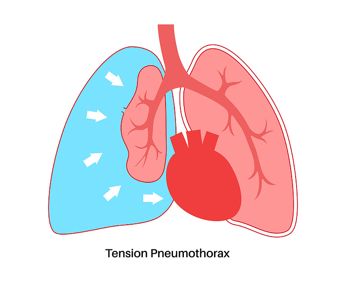 Tension pneumothorax, illustration Tension pneumothorax, illustration., by PIKOVIT   SCIENCE PHOTO LIBRARY