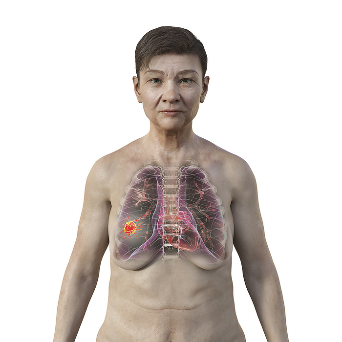 Woman with lung cancer, illustration Illustration of the upper part of a woman with transparent skin, revealing the presence of lung cancer., by KATERYNA KON SCIENCE PHOTO LIBRARY