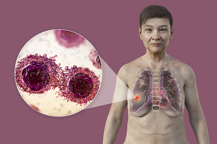 Woman with lung cancer, illustration Illustration of the upper part of a woman with transparent skin, revealing the presence of lung cancer, and a close up view of cancer cells., by KATERYNA KON SCIENCE PHOTO LIBRARY