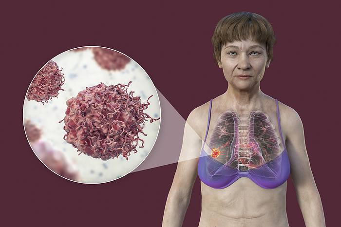 Woman with lung cancer, illustration Illustration of the upper part of a woman with transparent skin, revealing the presence of lung cancer, and a close up view of cancer cells., by KATERYNA KON SCIENCE PHOTO LIBRARY