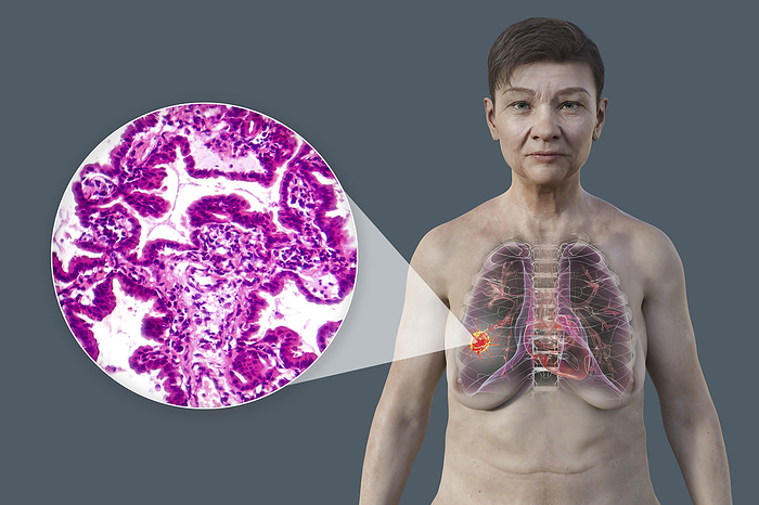 Woman with lung cancer, illustration Illustration of a woman with lung cancer, along with a micrograph image of lung adenocarcinoma., by KATERYNA KON SCIENCE PHOTO LIBRARY