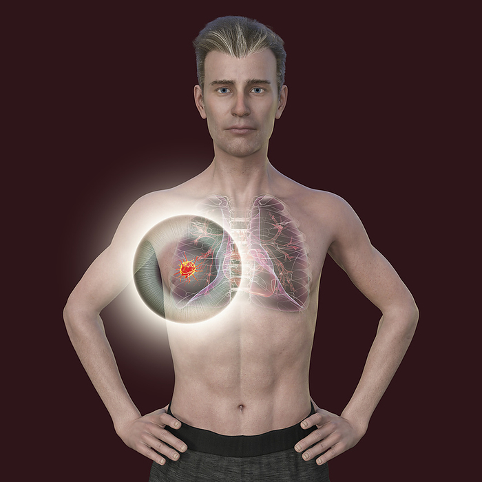 Man with lung cancer, illustration Illustration of the upper part of a man with transparent skin, revealing the presence of lung cancer., by KATERYNA KON SCIENCE PHOTO LIBRARY