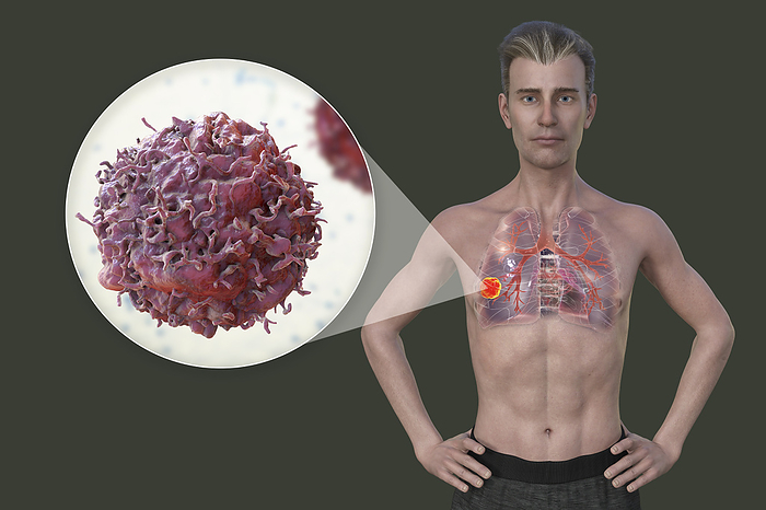 Man with lung cancer, illustration Illustration of the upper part of a man with transparent skin, revealing the presence of lung cancer, and a close up view of cancer cells., by KATERYNA KON SCIENCE PHOTO LIBRARY
