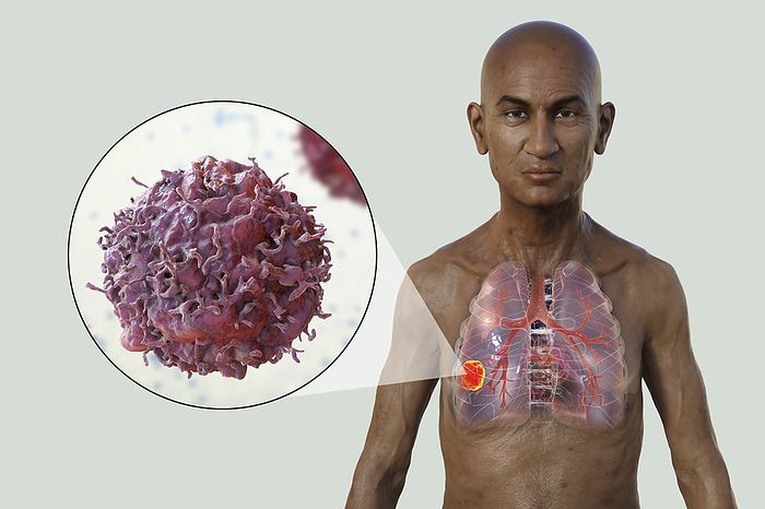 Man with lung cancer, illustration Illustration of the upper part of a man with transparent skin, revealing the presence of lung cancer., by KATERYNA KON SCIENCE PHOTO LIBRARY