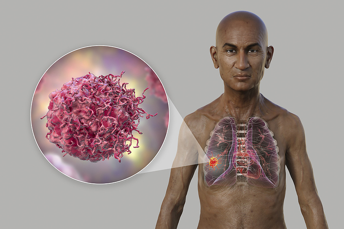Man with lung cancer, illustration Illustration of the upper half part of a man with transparent skin, revealing the presence of a tumour in lungs, with a close up view of cancer cells., by KATERYNA KON SCIENCE PHOTO LIBRARY