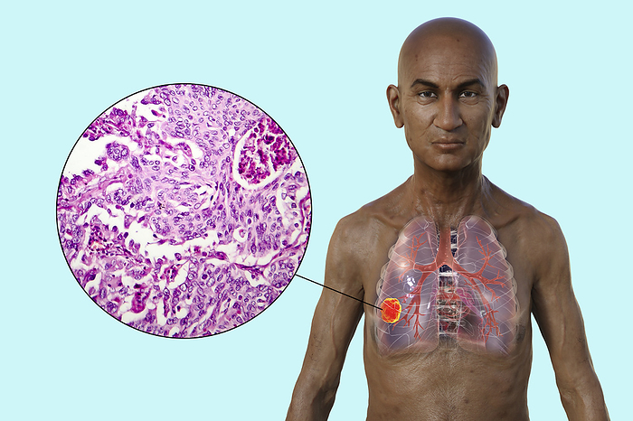 Man with lung cancer, illustration Illustration of the upper half part of a man with transparent skin, revealing the presence of a tumour in lungs, with a micrograph of lung adenocarcinoma., by KATERYNA KON SCIENCE PHOTO LIBRARY