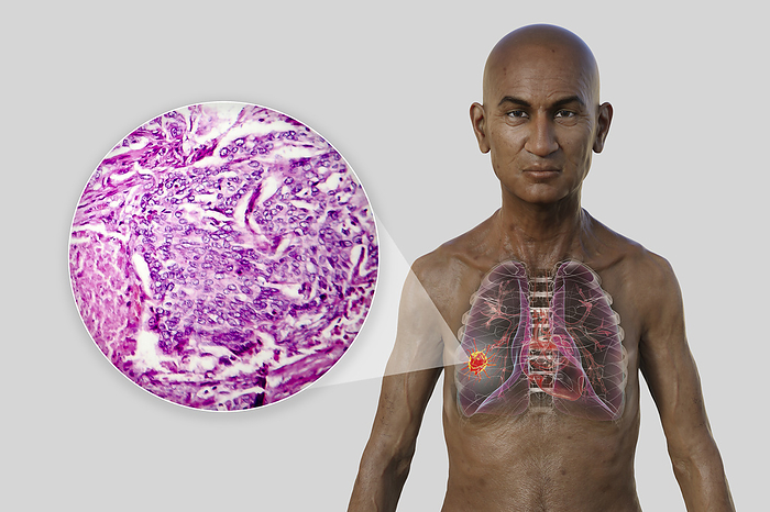 Man with lung cancer, illustration Illustration of the upper half part of a man with transparent skin, revealing the presence of a tumour in lungs, with a micrograph of lung adenocarcinoma., by KATERYNA KON SCIENCE PHOTO LIBRARY