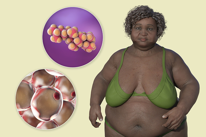 Overweight woman and adipocytes, illustration Illustration featuring an overweight woman with a close up view of adipocytes and cholesterol molecules, highlighting the relationship between obesity and cholesterol metabolism., by KATERYNA KON SCIENCE PHOTO LIBRARY