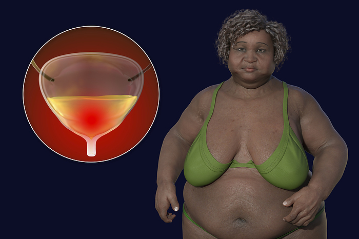 Senior overweight woman and urinary bladder, illustration Illustration of an overweight senior woman with a close up view of her urinary bladder, conceptualising urinary problems in obesity, including an overactive bladder., by KATERYNA KON SCIENCE PHOTO LIBRARY