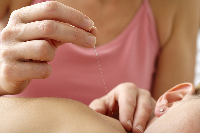 Close-up of Woman Getting Acupuncture Treatment, by Masterfile / Design Pics