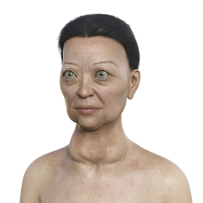Woman with Graves  disease, illustration Illustration depicting a woman with Graves  disease showing an enlarged thyroid gland and abnormal protrusion of the eyeballs  exophthalmos ., by KATERYNA KON SCIENCE PHOTO LIBRARY
