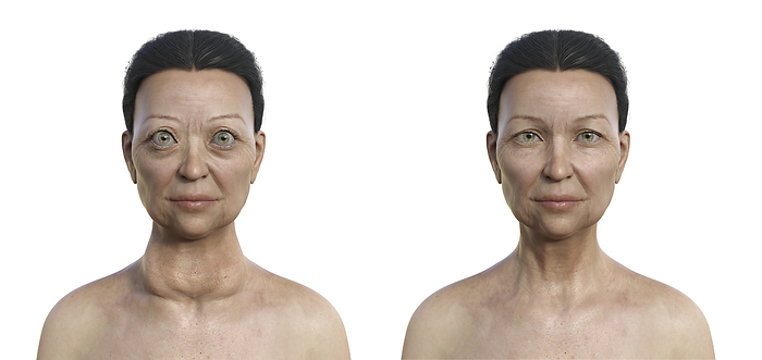 Woman with Graves  disease, illustration Illustration depicting a woman with Graves  disease showing an enlarged thyroid gland and abnormal protrusion of the eyeballs  exophthalmos, left  and the same healthy person for comparison  right ., by KATERYNA KON SCIENCE PHOTO LIBRARY