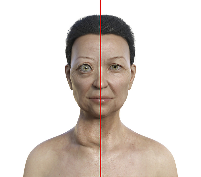 Woman with Graves  disease, illustration Illustration depicting a woman with Graves  disease showing an enlarged thyroid gland and abnormal protrusion of the eyeballs  exophthalmos, left  and the same healthy person for comparison  right ., by KATERYNA KON SCIENCE PHOTO LIBRARY