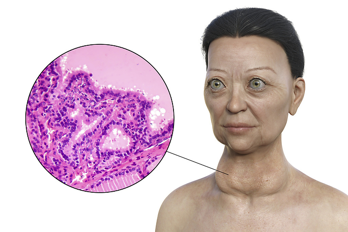 Woman with Graves  disease, illustration Illustration depicting a woman with Graves  disease showing an enlarged thyroid gland and abnormal protrusion of the eyeballs  exophthalmos , alongside a micrograph of thyroid tissue affected by Graves  disease., by KATERYNA KON SCIENCE PHOTO LIBRARY