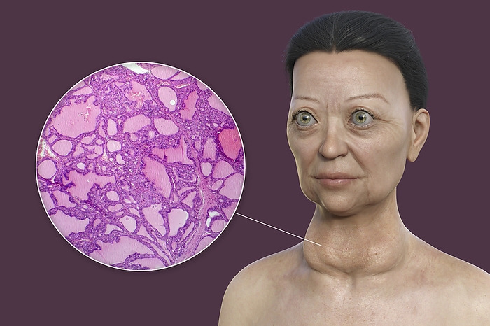 Woman with Graves  disease, illustration Illustration depicting a woman with Graves  disease showing an enlarged thyroid gland and abnormal protrusion of the eyeballs  exophthalmos , alongside a micrograph of thyroid tissue affected by Graves  disease., by KATERYNA KON SCIENCE PHOTO LIBRARY
