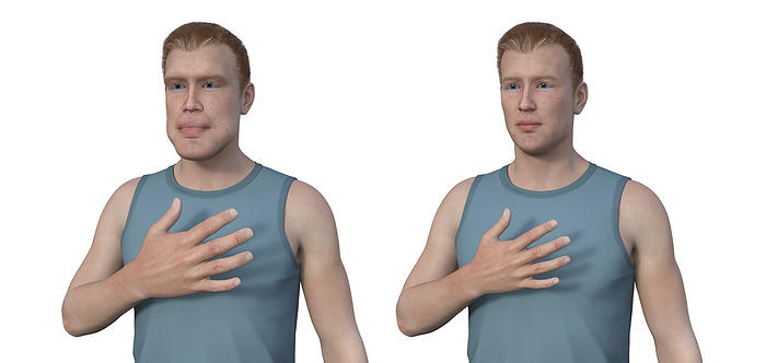 Acromegaly in a man compared to healthy man, illustration Illustration depicting acromegaly in a man  left  and the same healthy man  right . There is an increase in the size of the hand with acromegaly due to overproduction of somatotrophin caused by a tumour of the pituitary gland., by KATERYNA KON SCIENCE PHOTO LIBRARY