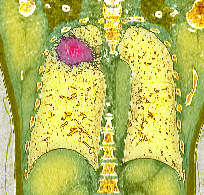 Lung cancer, CT scan Coloured coronal chest computed tomography  CT  scan of the lungs of a patient with lung cancer, showing a solid mass  pink  with an irregular border in the right lung. This is a carcinoma, a type of cancer that arises from the epithelial tissue that lines the lungs., by RAJAAISYA SCIENCE PHOTO LIBRARY