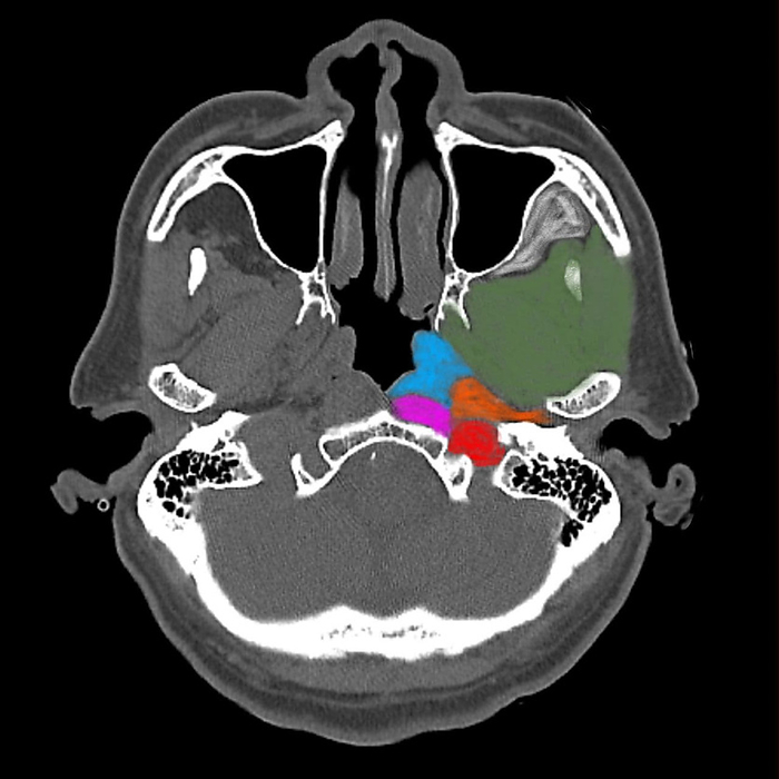 Deep neck space anatomy, CT scan Axial head computed tomography  CT  scan showing the anatomy of the deep neck space. The green area is the masticator space, the blue area is the pharyngeal mucosal space, the orange area is the parapharyngeal space, the red areas is the carotid space and the purple area is the perivertebral space., by RAJAAISYA SCIENCE PHOTO LIBRARY